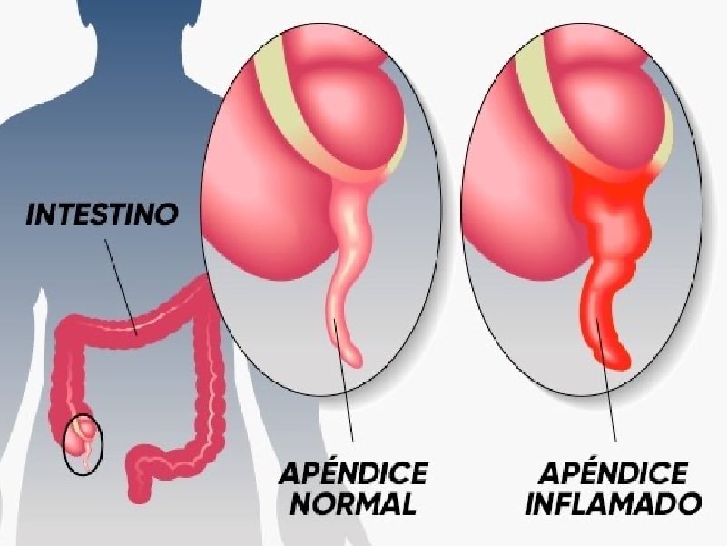 Apendicitis Cirugía Quito Dra Marta Cueva-min