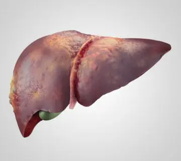 Cancer de Higado Quito Dra Marta Cueva-min