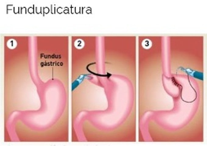 Cirugía Antirreflujo Quito Dra Marta Cueva