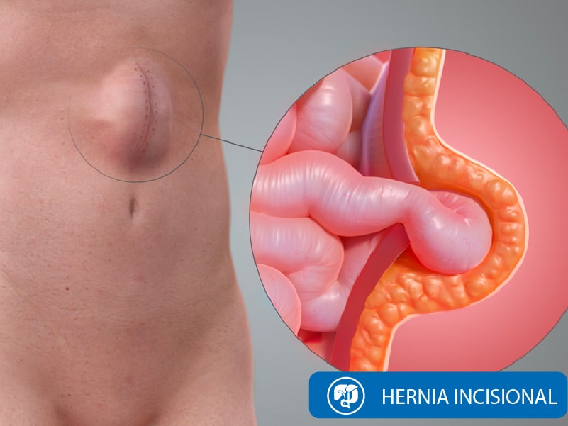 Cirugía Hernia Incisional Quito Dra Marta Cueva5-min