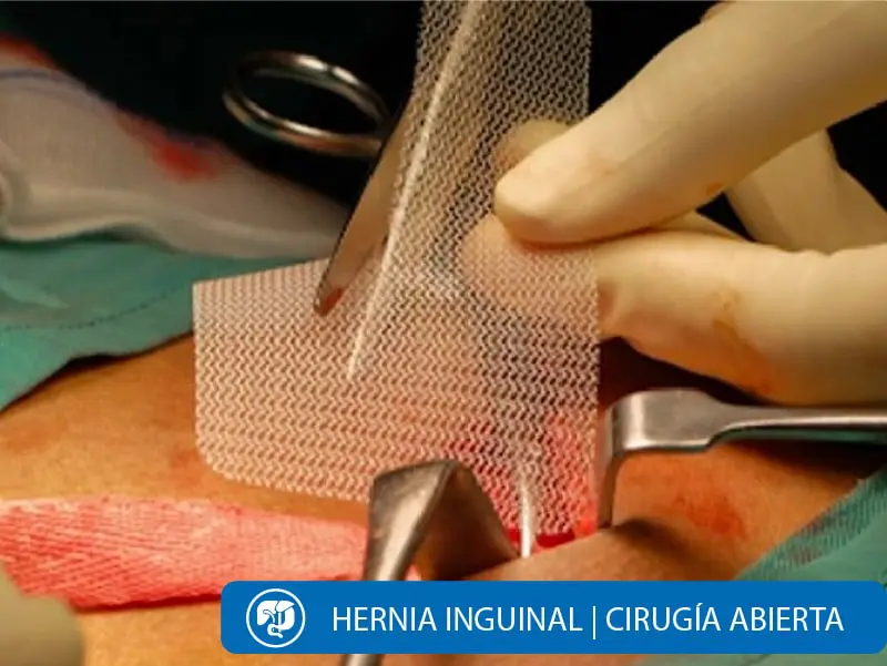 Cirugía Hernia Inguinal Quito Dra Marta Cueva1-min