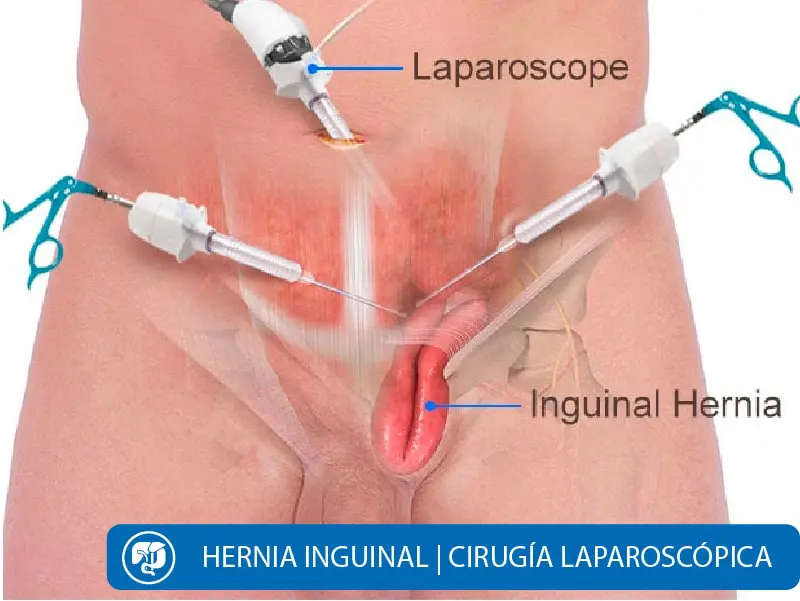 Cirugía Hernia Inguinal Quito Dra Marta Cueva1-min