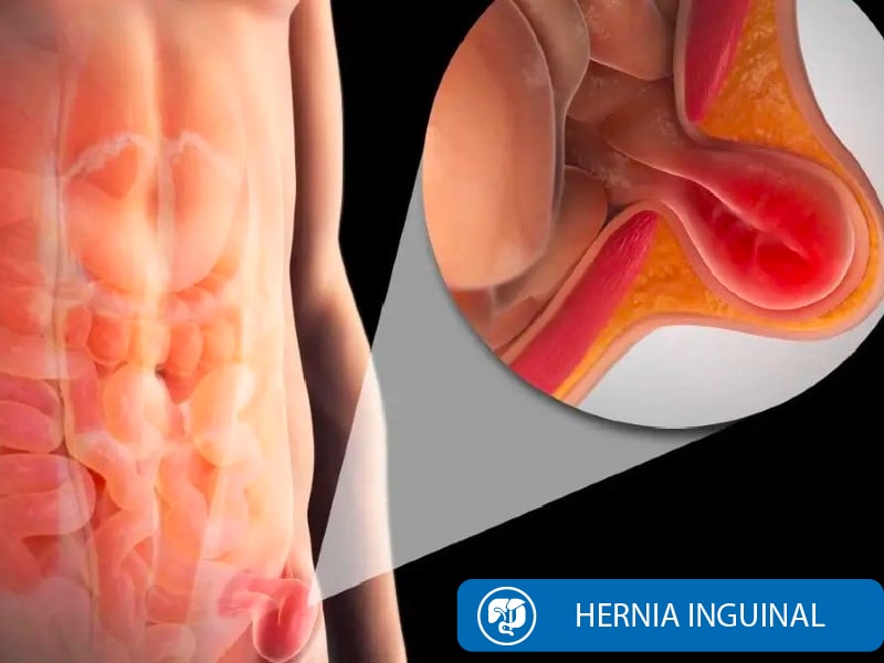 Cirugía Hernia Inguinal Quito Dra Marta Cueva2-min