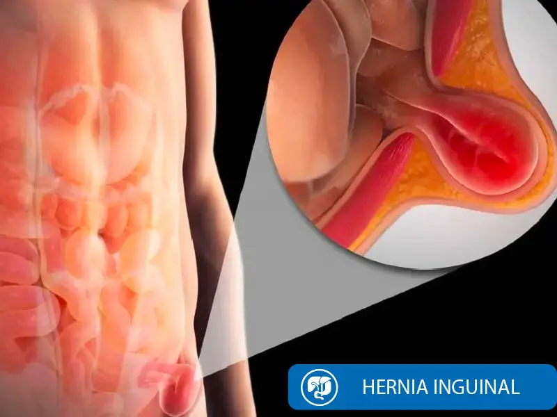 Cirugía Hernia Inguinal Quito Dra Marta Cueva2-min