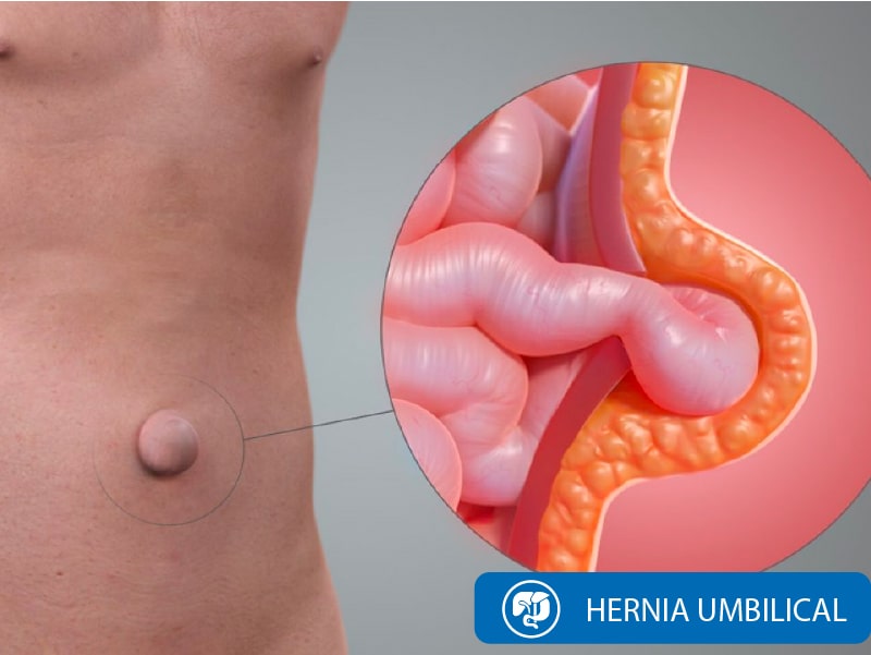 Cirugía Hernia Umbilical Quito Dra Marta Cueva4-min