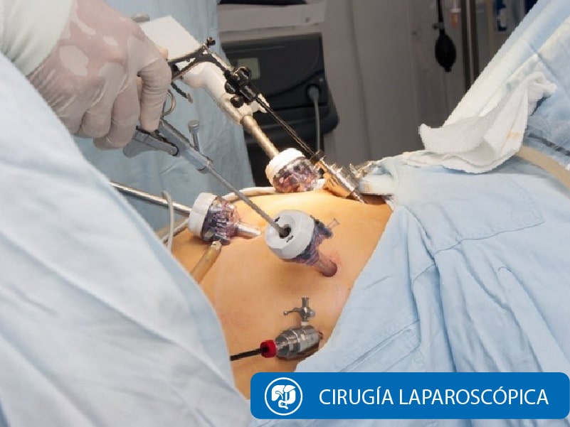 Cirugía de Higado Laparoscópica Cáncer de Hígado Dra Marta Cueva-min