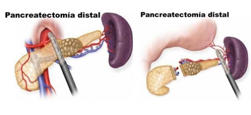 Pancreotomía y Pancreotomía Distal Cirujano de Pancreas Quito Dra Marta cueva-min