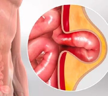 Hernia cirugia quito costo Dra Marta Cueva Hospital Metropolitano-min