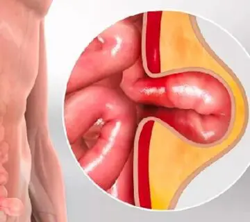 Hernia cirugia quito costo Dra Marta Cueva Hospital Metropolitano-min
